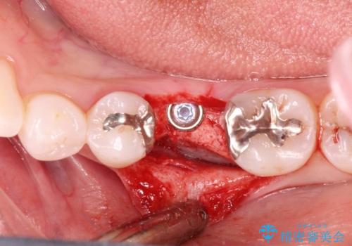 深い虫歯により抜歯となった奥歯 インプラント治療でかみ合わせを回復するの治療中