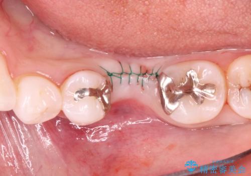 深い虫歯により抜歯となった奥歯 インプラント治療でかみ合わせを回復するの治療中