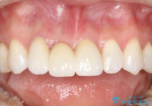 前歯がぐらぐらする 抜歯→ブリッジへ の治療後