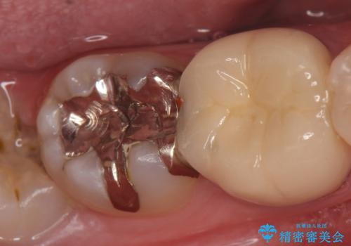 セラミックインレー 古い銀歯の治療の治療前
