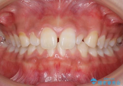 前歯のすきま　矯正治療とセラミックで小さな歯を形良くの症例 治療前