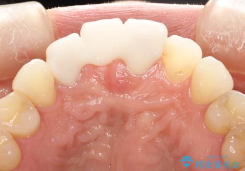 前歯がぐらぐらする 抜歯→ブリッジへ の治療後