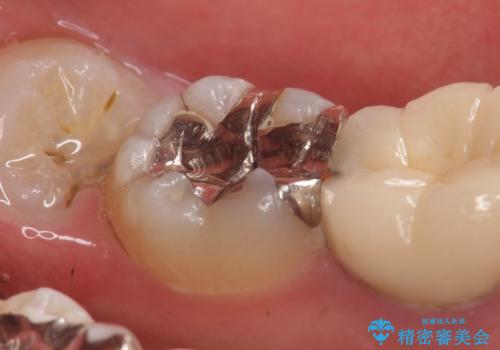セラミックインレー 古い銀歯の治療の治療前