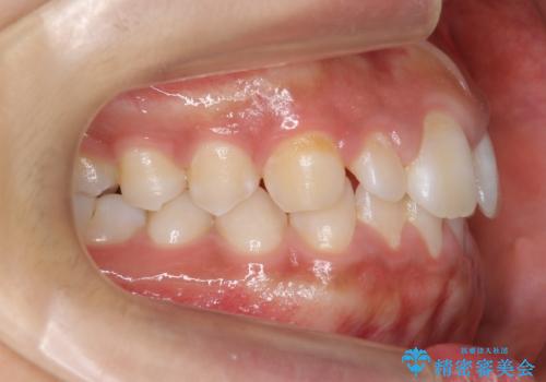 前歯のすきま 矯正治療とセラミックで小さな歯を形良くの治療前