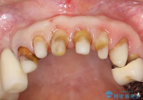 前歯の低クオリティな治療の実態　妥協無い治療で根本からやり治すの治療後