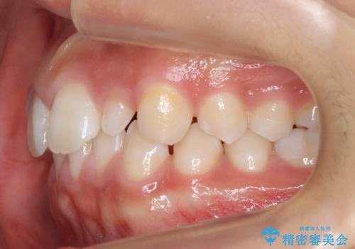 前歯のすきま　矯正治療とセラミックで小さな歯を形良くの治療前