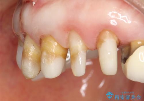前歯の低クオリティな治療の実態 妥協無い治療で根本からやり治すの治療後