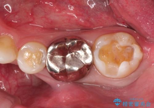 [金属の詰め物内部にむし歯] 奥歯のセラミックインレーの治療中