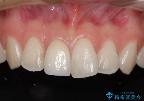 変色した歯をセラミックにしたい 歯自体が変色している場合の参考用2の治療後