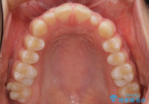 前歯のすきま 矯正治療とセラミックで小さな歯を形良くの治療前