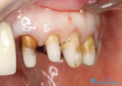 前歯の低クオリティな治療の実態 妥協無い治療で根本からやり治すの治療後