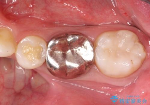 [金属の詰め物内部にむし歯] 奥歯のセラミックインレーの症例 治療後