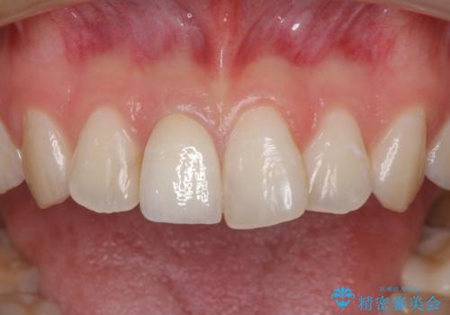 変色した歯をセラミックにしたい　歯自体が変色している場合の参考用2の治療後