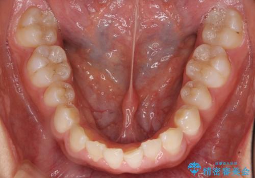 前歯のすきま 矯正治療とセラミックで小さな歯を形良くの治療前
