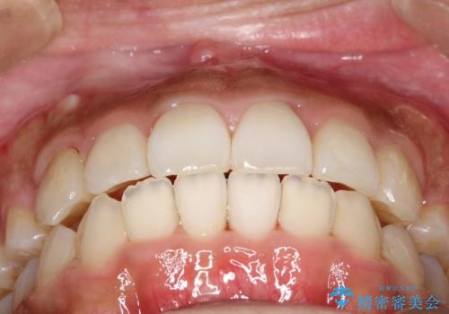 人生が変わる 困難を極める咬合状態に歯列矯正単独で挑戦するの治療後
