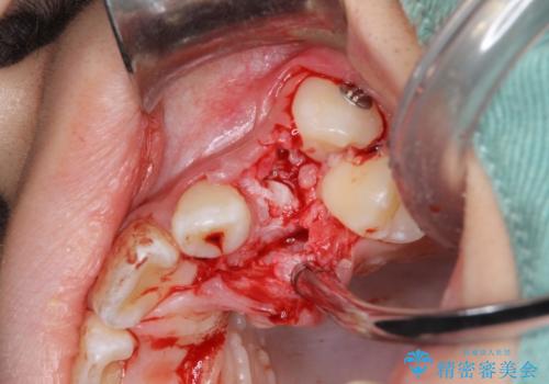 永久歯が生えてこない ワイヤー矯正で複雑な状態を正常咬合へ誘導するの治療中