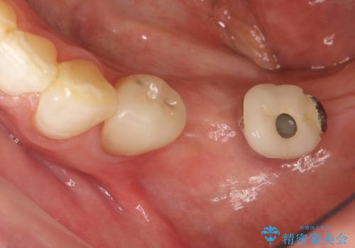 奥歯がない　インプラント治療でかみあわせを回復の症例 治療前