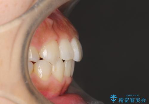 人生が変わる 困難を極める咬合状態に歯列矯正単独で挑戦するの治療後