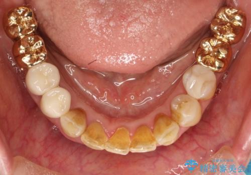 片顎の部分矯正 ワイヤーを用いて短期間でガタつきを改善するの治療後