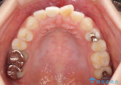 変色した歯をセラミックにしたい 歯自体が変色している場合の参考用2の治療後
