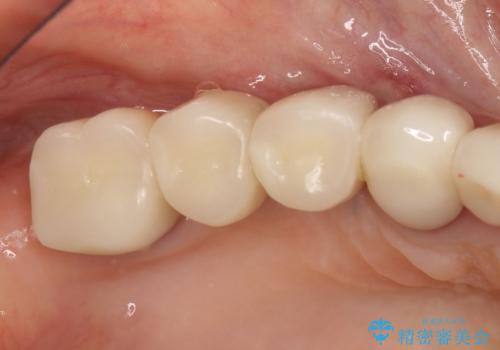 薄い骨にもインプラントを スプリットクレスト+ショートインプラントの応用の治療後