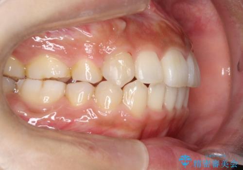 人生が変わる　困難を極める咬合状態に歯列矯正単独で挑戦するの症例 治療後
