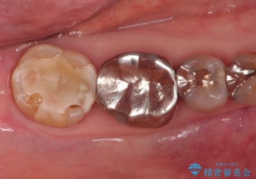 セラミッククラウンによるむし歯治療の治療前