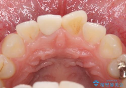変色した歯をセラミックにしたい 歯自体が変色している場合の参考用2の治療後