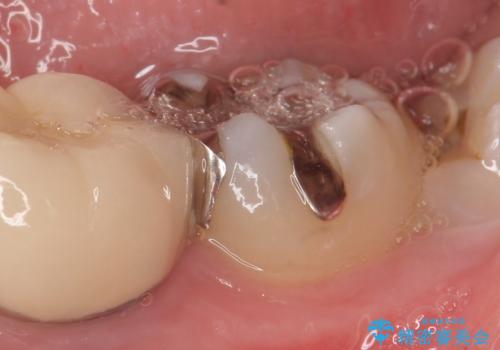 セラミックインレー 古い銀歯の治療の治療前