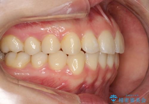 インビザラインによるガタつきの矯正治療 シンプル・短期間の治療後