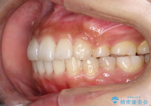 人生が変わる 困難を極める咬合状態に歯列矯正単独で挑戦するの治療後