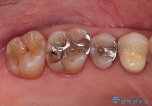 セラミッククラウンによるむし歯治療の治療前