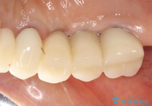 薄い骨にもインプラントを スプリットクレスト+ショートインプラントの応用の治療後