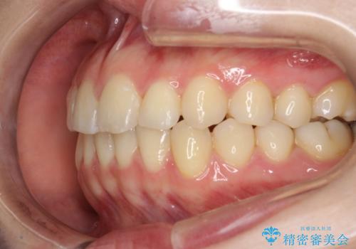 インビザラインによるガタつきの矯正治療 シンプル・短期間の治療後