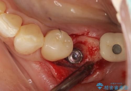 奥歯がない　インプラント治療でかみあわせを回復の治療中