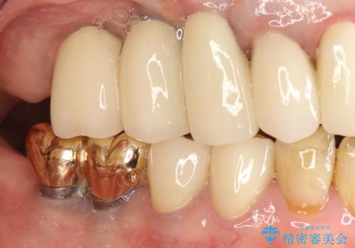 薄い骨にもインプラントを スプリットクレスト+ショートインプラントの応用の治療後