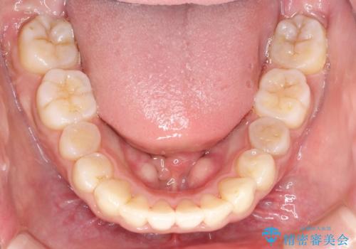 人生が変わる 困難を極める咬合状態に歯列矯正単独で挑戦するの治療後