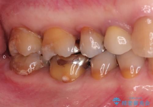 セラミッククラウンによるむし歯治療の症例 治療前