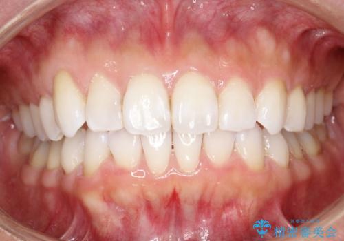 抜歯せずに八重歯のマウスピース矯正の治療後