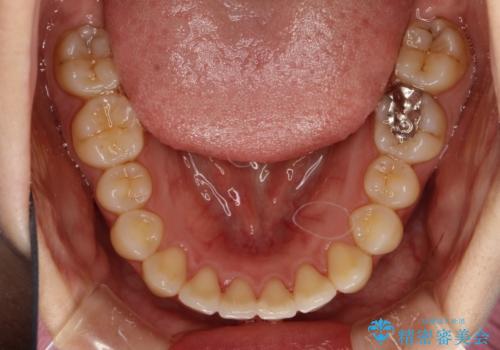 インビザラインによるガタつきの矯正治療 シンプル・短期間の治療後