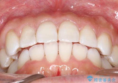 抜歯せずに八重歯のマウスピース矯正の治療後