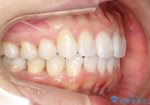 抜歯せずに八重歯のマウスピース矯正の治療後