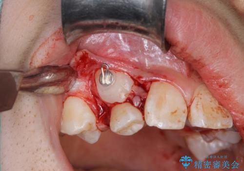 永久歯が生えてこない　ワイヤー矯正で複雑な状態を正常咬合へ誘導するの治療中