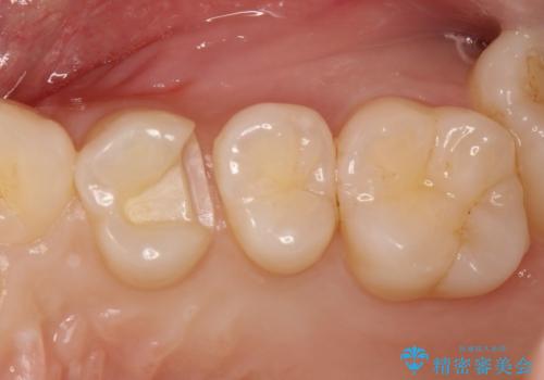 気づかないうちに大きな虫歯が 神経を保存し、セラミックで修復の治療中