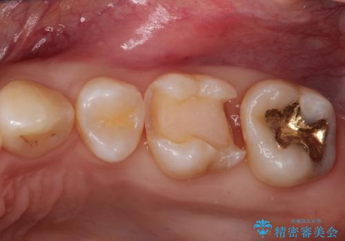 一度治療した歯が虫歯に セラミックインレーで治療の治療中