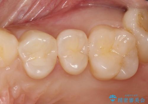 気づかないうちに大きな虫歯が 神経を保存し、セラミックで修復の症例 治療後