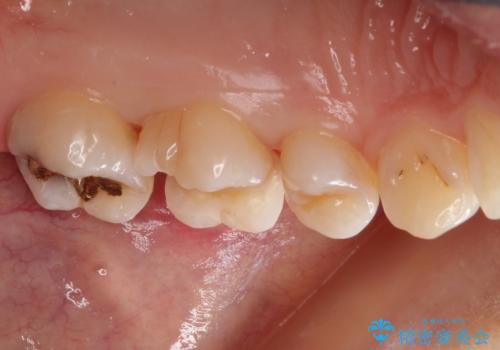 一度治療した歯が虫歯に　セラミックインレーで治療の治療中