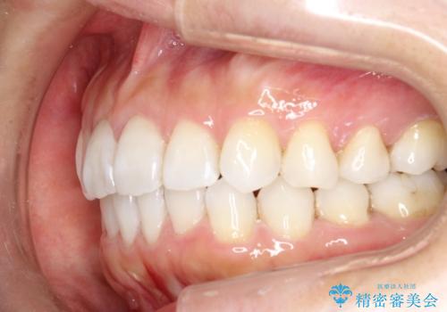 抜歯せずに八重歯のマウスピース矯正の治療後