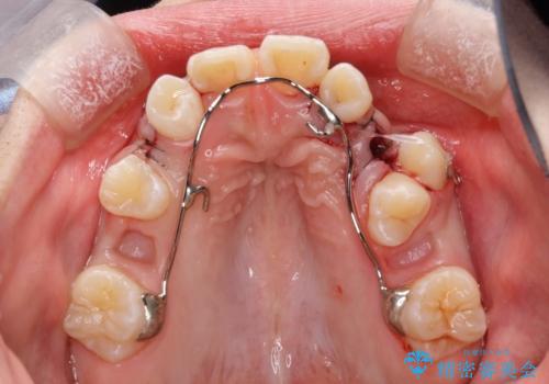 永久歯が生えてこない ワイヤー矯正で複雑な状態を正常咬合へ誘導するの治療中