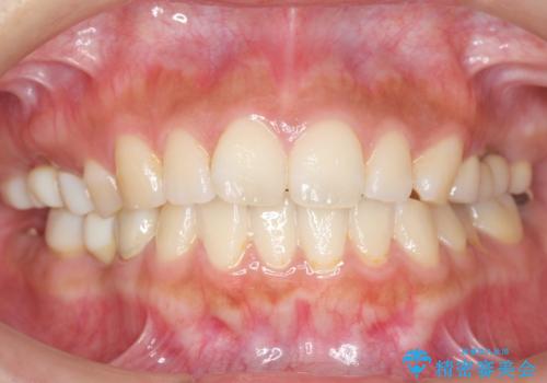 自家歯牙移植 使っていない親知らずを移植 20代女性の治療後